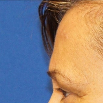56 year old woman treated with Lipoma Removal from Forehead after 2065265