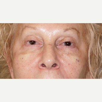 woman treated with Injectable Fillers to the cheeks and under eyes, immediate results after 2838287