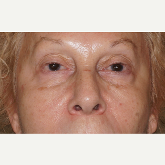 woman treated with Injectable Fillers to the cheeks and under eyes, immediate results before 2838287