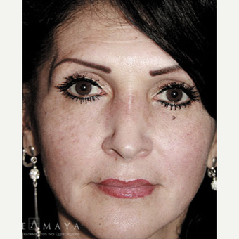 45-54 year old woman treated with Skin Lightening after 3417721