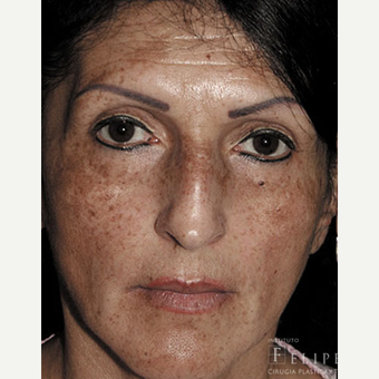 45-54 year old woman treated with Skin Lightening before 3417721