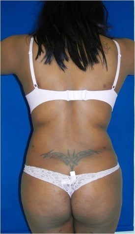 Laser Lipo after 333238