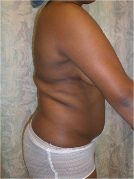 Laser Lipo 333238