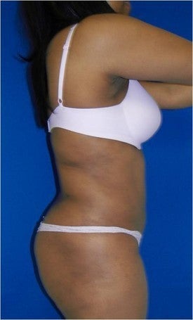 Laser Lipo 333238