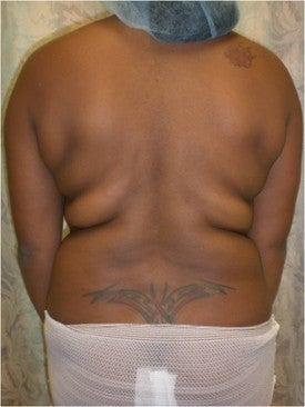 Laser Lipo before 333238