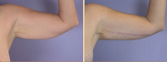 Arm Lift before 272273