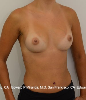 26 year old woman treated with Breast Augmentation 1756171
