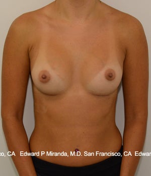 26 year old woman treated with Breast Augmentation after 1756171