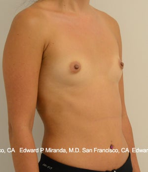 26 year old woman treated with Breast Augmentation 1756171