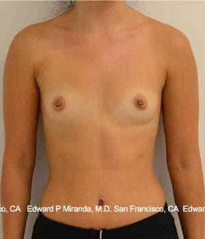 26 year old woman treated with Breast Augmentation before 1756171