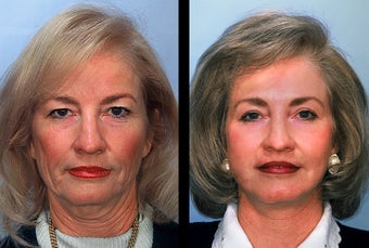 Female Radiesse Patient before 937795