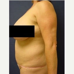 45-54 year old woman treated with Mini Tummy Tuck before 2058569