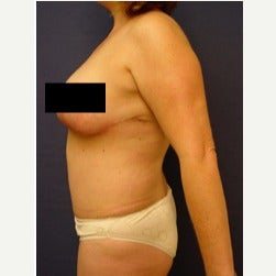 45-54 year old woman treated with Mini Tummy Tuck after 2058569