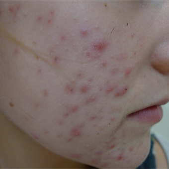 18-24 year old man treated with Acne Treatment before 3710552