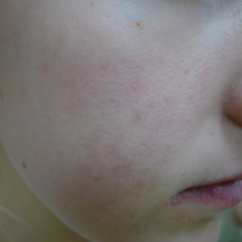 18-24 year old man treated with Acne Treatment after 3710552