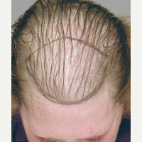 Hair Transplant before 3241487