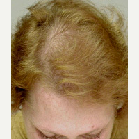 Hair Transplant after 3241487
