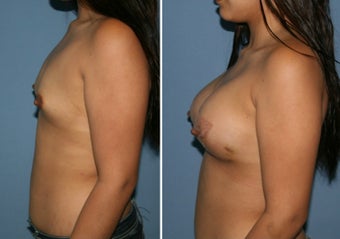 18-24 year old woman treated with Breast Augmentation after 3170052
