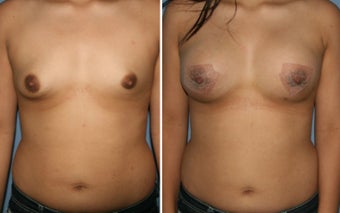 18-24 year old woman treated with Breast Augmentation before 3170052