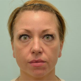 34 year old woman treated with Voluma, Restylane, and Dysport before 2589214