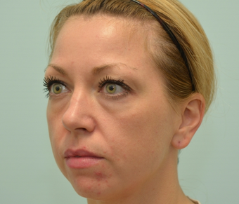 34 year old woman treated with Voluma, Restylane, and Dysport 2589214