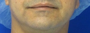 Chin Implant before 3164303