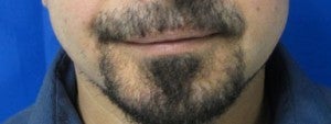 Chin Implant after 3164303