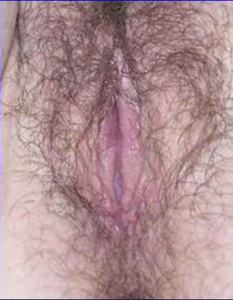 Vaginoplasty and Labiaplasty Before and After after 656626