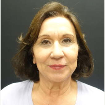 65-74 year old woman treated with Lower Face Lift before 3244876