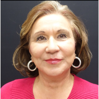 65-74 year old woman treated with Lower Face Lift after 3244876