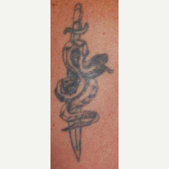 45-54 year old man Treated with PicoSure Laser for Tattoo Removal before 3149647