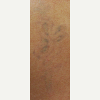 45-54 year old man Treated with PicoSure Laser for Tattoo Removal after 3149647