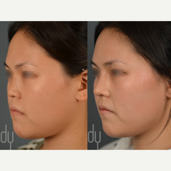 Asian Rhinoplasty before 3116201