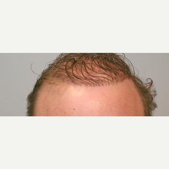 Hair Transplant before 3241403