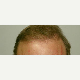 Hair Transplant after 3241403