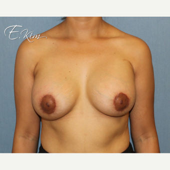 25-34 year old woman treated with Breast Lift after 3663454