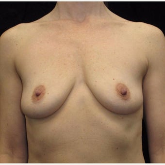 43 year old woman treated with Breast Augmentation before 2285060