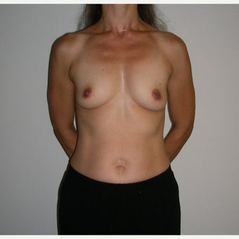 Breast Augmentation before 1690492
