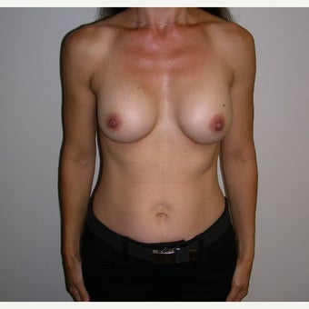 Breast Augmentation after 1690492