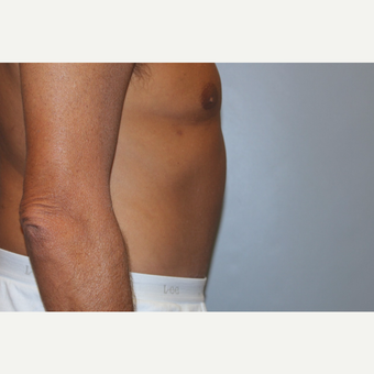 55-64 year old man treated with Tummy Tuck after 3529042