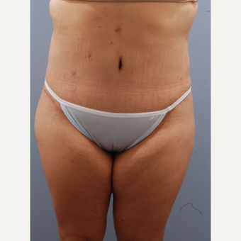 25-34 year old woman treated with Tummy Tuck after 3590067