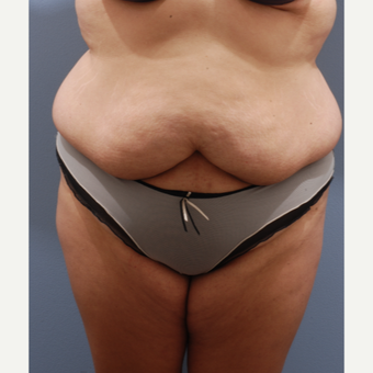 25-34 year old woman treated with Tummy Tuck before 3590067