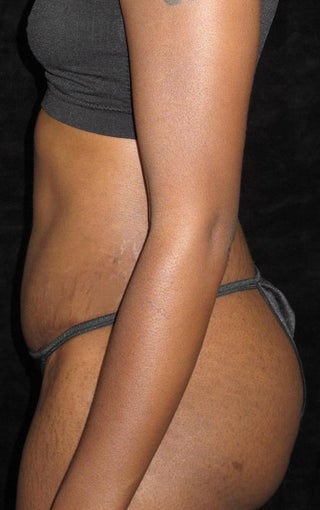 27 year old woman treated with Tummy Tuck 3656851