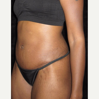 27 year old woman treated with Tummy Tuck after 3656851