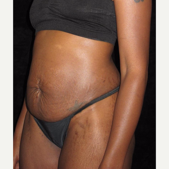 27 year old woman treated with Tummy Tuck before 3656851