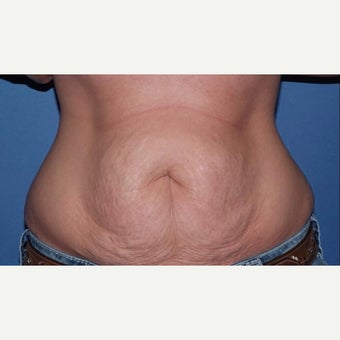 Mom gets her beautiful tummy back with tummy tuck (abdominoplasty) before 2246182