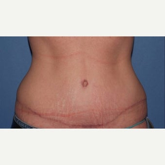 Mom gets her beautiful tummy back with tummy tuck (abdominoplasty) after 2246182