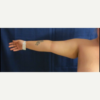 25-34 year old woman treated with Arm Lift before 3831711