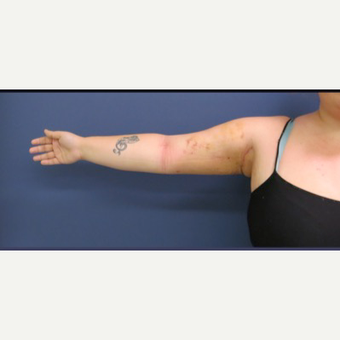 25-34 year old woman treated with Arm Lift after 3831711