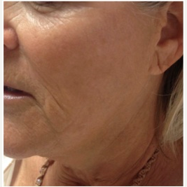 55-64 year old woman treated with Infini RF before 3642497
